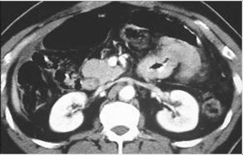 Learningradiology Acute Abdominal Emergencies