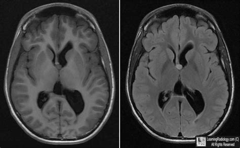 Third Ventricle Mri