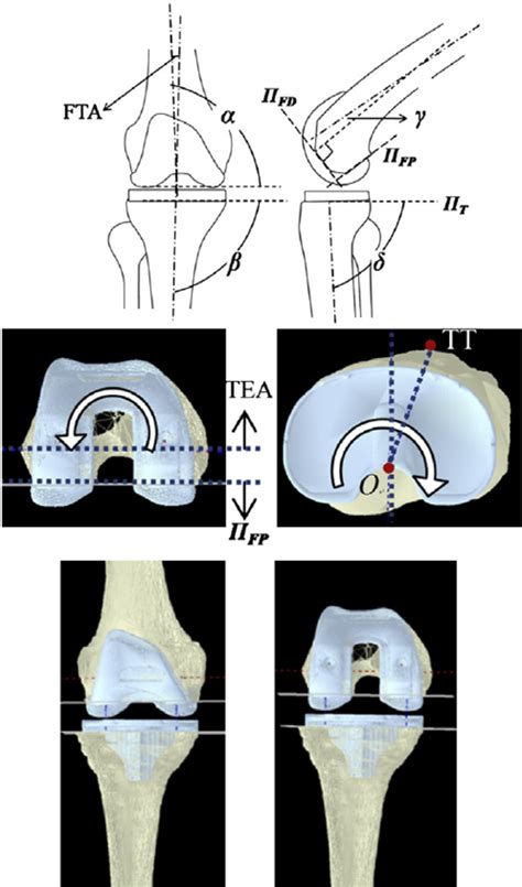 Top De Fi Nition Of The Relative Angles Of The Bone And The Implant