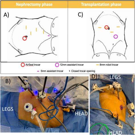 Trocar Positioning Using The Da Vinci Xi System Ab Nephrectomy Download Scientific Diagram