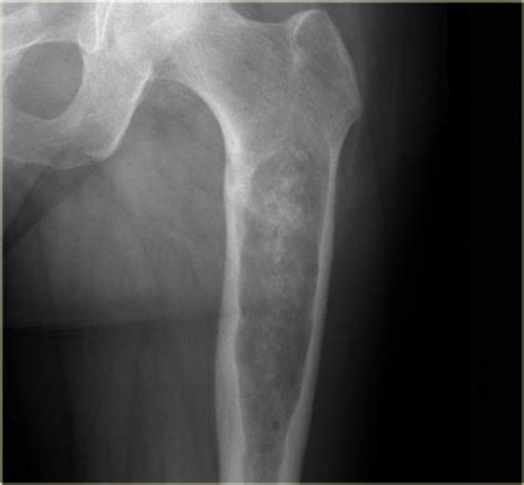 Chondrosarcoma | The Bone School