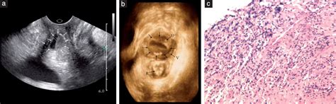 Transvaginal Sonographic Features Of Perineal Masses In The Female