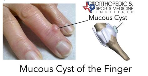 Mucous Cyst of the Finger Diagnosis and Treatment