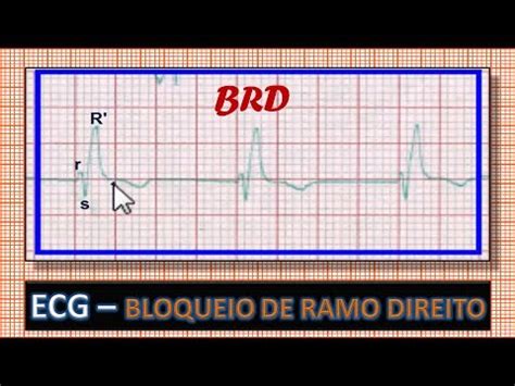 Ecg Eletrocardiograma Bloqueio De Ramo Direito Youtube