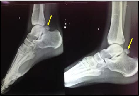 Figure 1 From Endoscopic Management Of Posterior Ankle Impingement Syndrome A Case Report