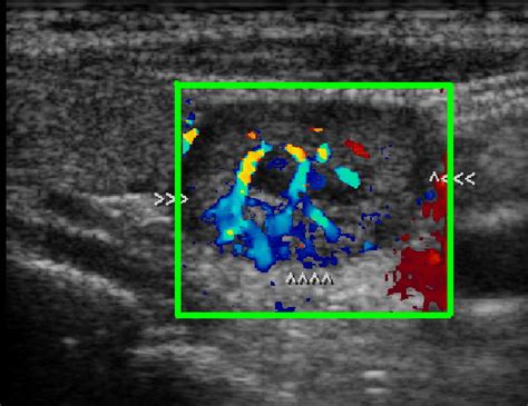 Colour Doppler Sonogram Shows A Typical Hypoechoic Adenoma Deep In