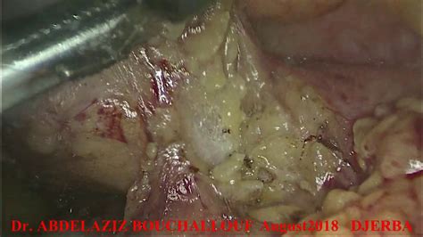 Lymphe Node Biopsie By Laparoscopy Peritoneal Tuberculosis YouTube