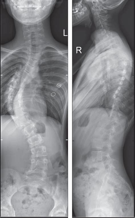 Anteroposterior And Lateral X Rays Demonstrating Right Sided Scoliosis