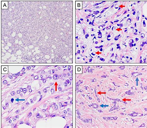 Morphological Variants Of Invasive Lobular Carcinoma A D Download Scientific Diagram