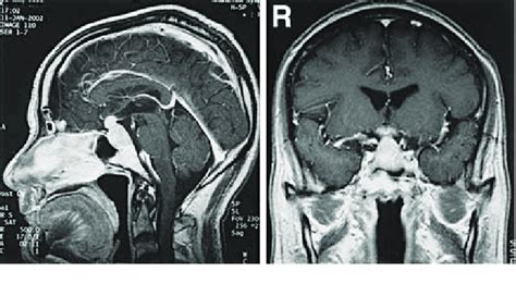 Sagittal Left And Coronal Right Magnetic Resonance Images With