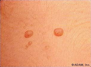 The New York Times Health Image Molluscum Contagiosum Close Up