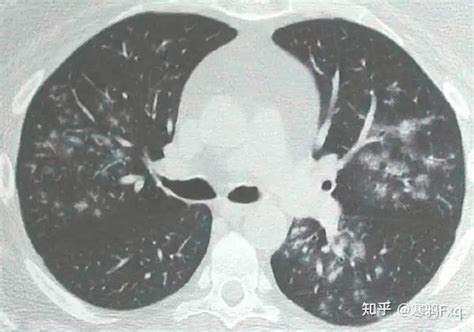 大叶性肺炎小叶性肺炎间质性肺炎的影像学表现 知乎