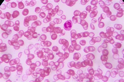 Sickle Cell Microscope Stock Photos, Pictures & Royalty-Free Images - iStock