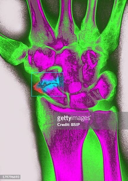 Hypertrophic Pseudarthrosis Photos and Premium High Res Pictures ...