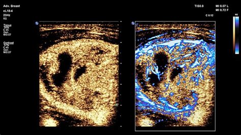 CEUS Contrast Enhanced Ultrasound Philips