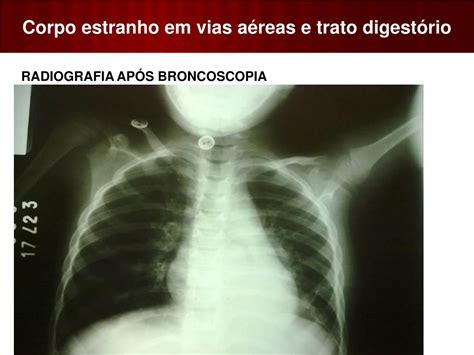 Ppt Corpo Estranho Em Vias A Reas E Trato Digest Rio Powerpoint