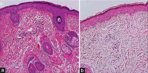 Comparison Of Acquired Bilateral Nevus Of Ota Like Macules In Men And