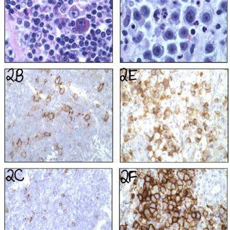 Figure2: A) Initial retroperitoneal lymph node biopsy (H&E stain, oil ...