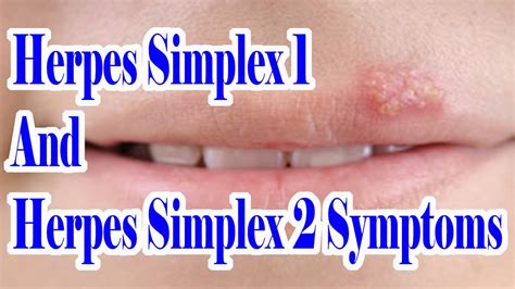 Herpes Simplex 1 And 2 Symptoms Which Herpes You Are Suffering From Hsv 1 Or Hsv 2 Youtube