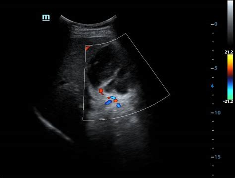 Gallbladder Empyema Image