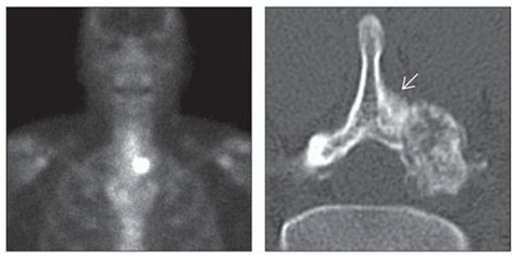 Osteoblastoma Basicmedical Key