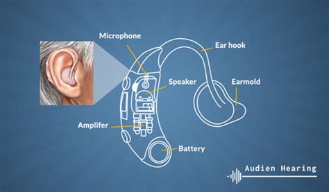 Hearing Aids For Conductive Hearing Loss