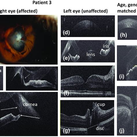 Anterior Segment Photography A And Spectral Domain Optical Coherence Download Scientific