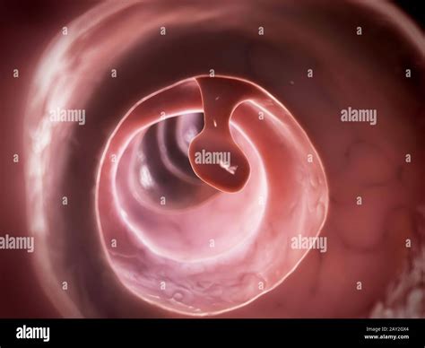 3d Rendered Illustration Of A Colon Polyp Stock Photo Alamy