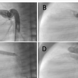 Stenting A Long Tubular Patent Ductus Arteriosus Pda From The