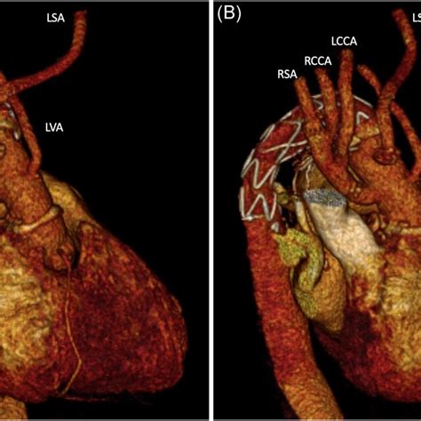 Postoperative Three‐dimensional Ct‐scan Reconstruction Of The Vascular