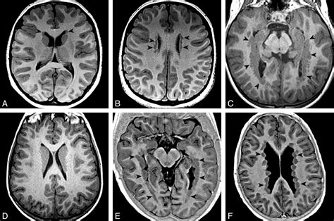 Location Of Periventricular Nodular Heterotopia Is Related To The