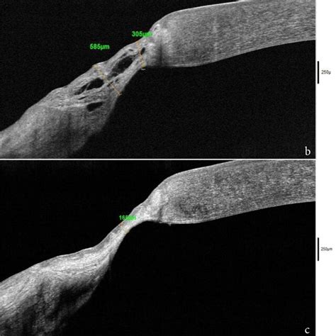 Anterior segment-OCT (RtVue-100®, Optovue®) scans of the thinnest zone ...