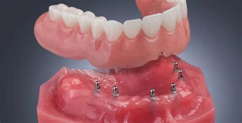 Implant Overdentures Utica Dental Laboratory