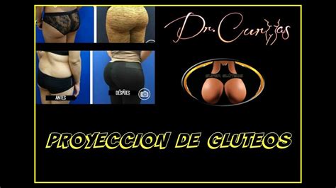 Levantamiento de Glúteos y Aumento de Gluteos con Lipotransferencia