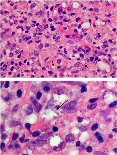 Case Report Mucosal Leishmaniasis In New York City In The American