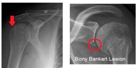 Ortho X Ray Findings Flashcards Quizlet