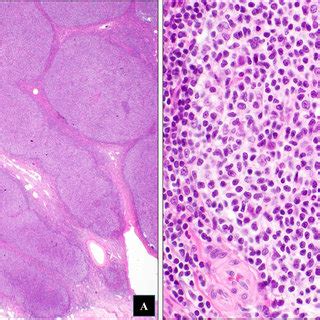 Low Grade Follicular Lymphoma Transforming Into Diffuse Large B Cell