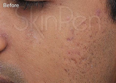 SkinPen Microneedling Fight Facial Acne Scars Crown Aesthetics