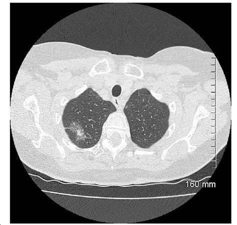 Ais On Ct A 33 Mm Ground Glass Opacity In The Superior Segment Of The Download Scientific