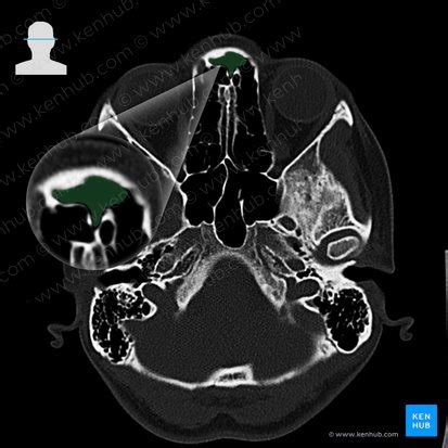 Frontal sinus: Anatomy and function | Kenhub