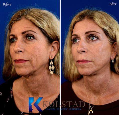 San Diego Full Facelift Results 3 Dr Kolstad San Diego Facial