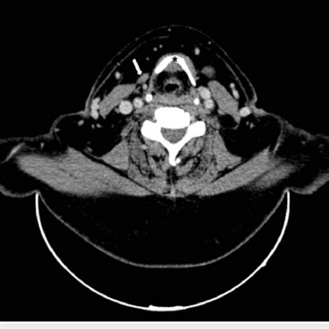 Contrast Enhanced Computed Tomography Scan Of The Neck Axial View Download Scientific