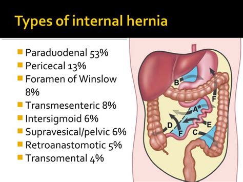 Internal hernia | PPT