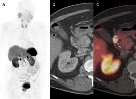 Ga Dotatate Pet Ct Results A Anterior Ga Dotatate Mip B Axial