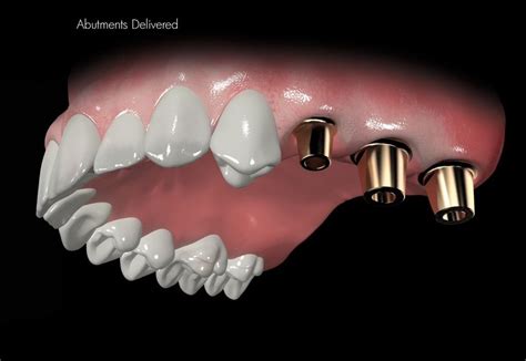 Bone Graft Swansea Sinus Lift Dental Implants Swansea