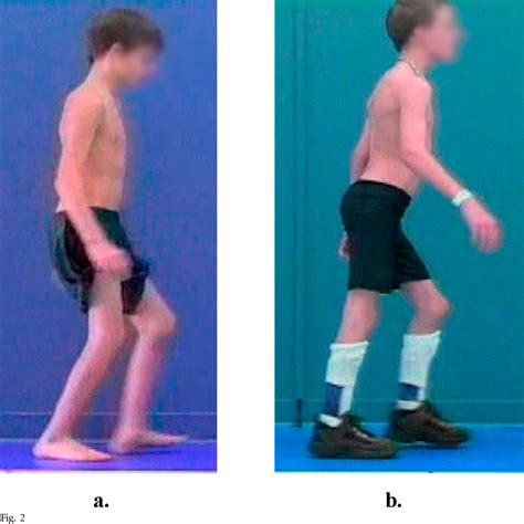 Figure 2 From The Efficacy Of The Floor Reaction Ankle Foot Orthosis In