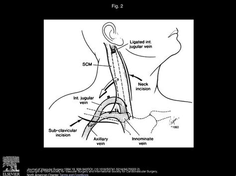 Internal Jugular To Axillary Vein Bypass For Subclavian Vein Thrombosis