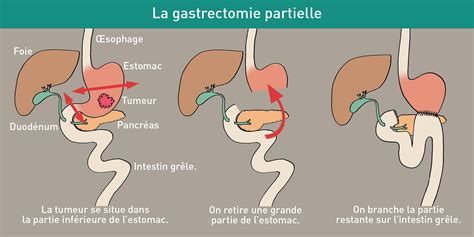 Gastrectomie Clinique Saint Amé