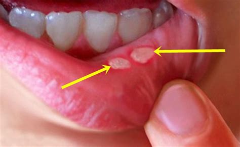 Llagas En La Boca Qu Son Y Por Qu Salen Las Aftas Bucales Gaceta Hot