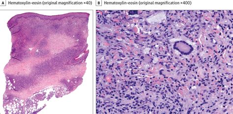 Necrobiotic Xanthogranuloma Treated With Topical Nitrogen Mustard